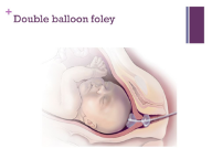 Double balloon foley