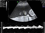 PGY-3 Sonagram Image of baby