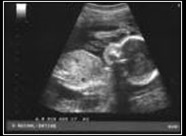 PGY-1 sonagram of baby PGY-1 sonagram of baby