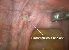 Endometriosis implant