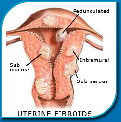 Uterine fibroids