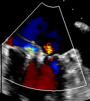 After: TEE image of posterior leaflet flail with trace MR following procedure