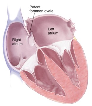 PFO and Cryptogenic Stroke Atrium Health