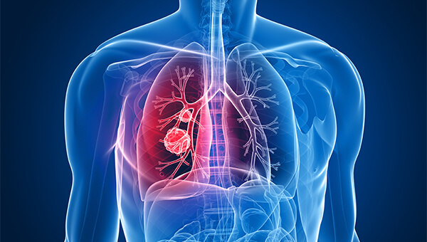 Artist rendering of human chest with lungs outlined, and area with a cancer mass highlighted.