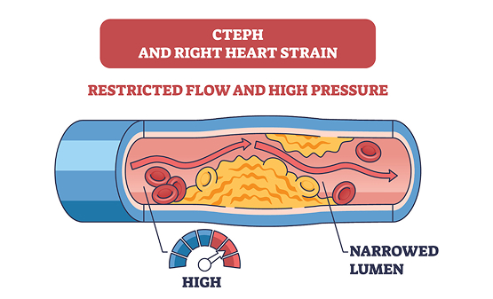 Image showing blood flow blockage in the pulmonary arteries caused by CTEPH