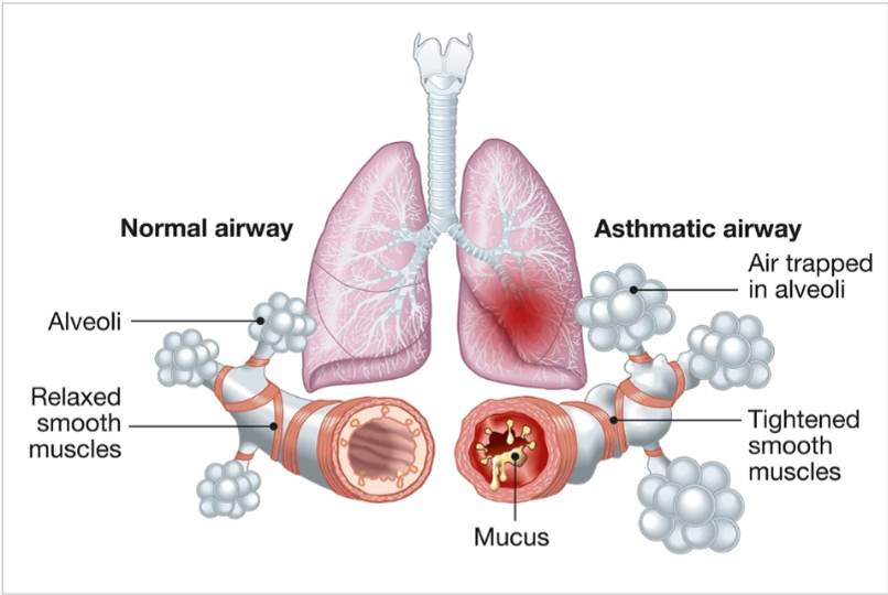 Visual differences between a normal airway and an asthmatic airway  
