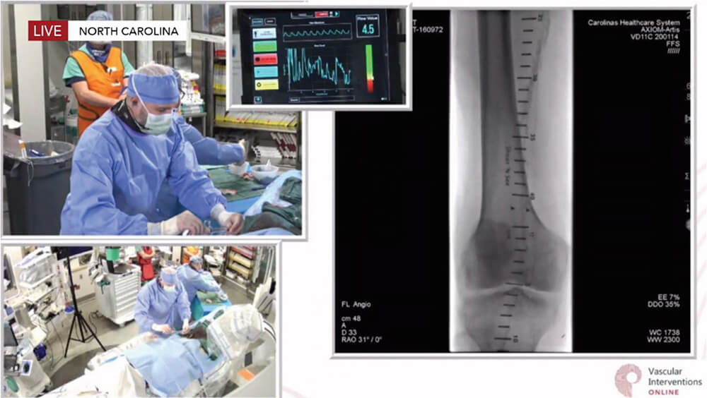 Image depicting team participating in live case presentations of vascular interventions, including thoracic endograft repair and iliac artery recanalization, that were broadcast to thousands of providers worldwide. 