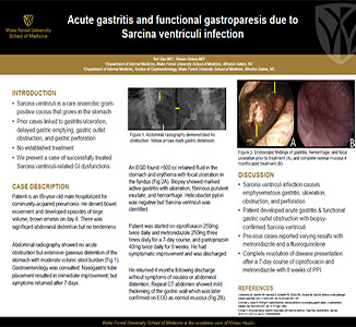 cute Gastritis and Functional Gastroparesis due to Sarcina Ventriculi Infection by Ted Xiao, MD