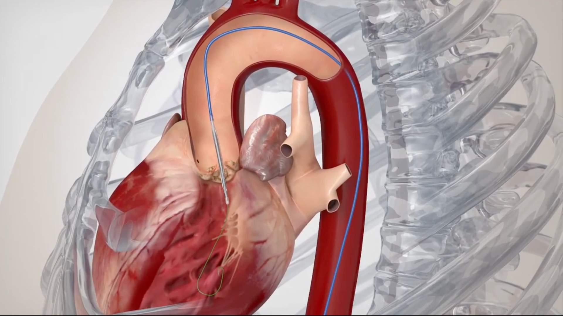 Atrium Health Sanger Heart & Vascular Institute has hit a milestone in heart care, having performed 2,022 transcatheter aortic valve replacements (TAVR)