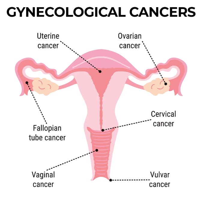 Image shows the location of each of the following types of gyn cancers; uterine cancer, ovarian cancer, fallopian tube cancer, cervical cancer, vaginal cancer and vulvar cancer.
