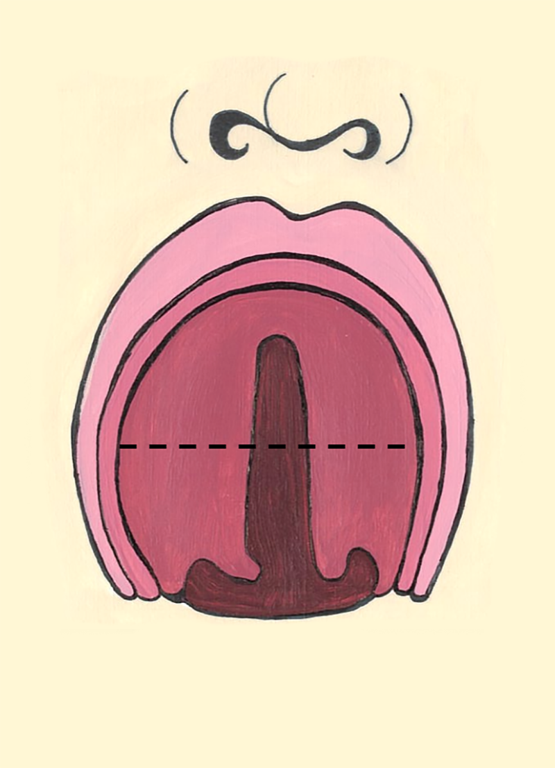 Cleft Soft Hard Palate