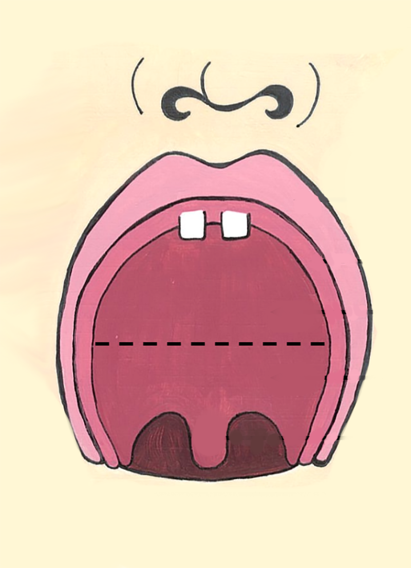 Lip Palate Typical