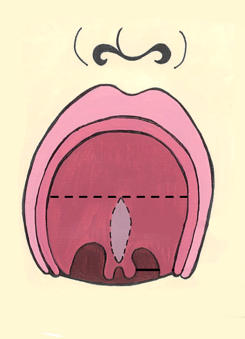 Submucous Cleft Palate