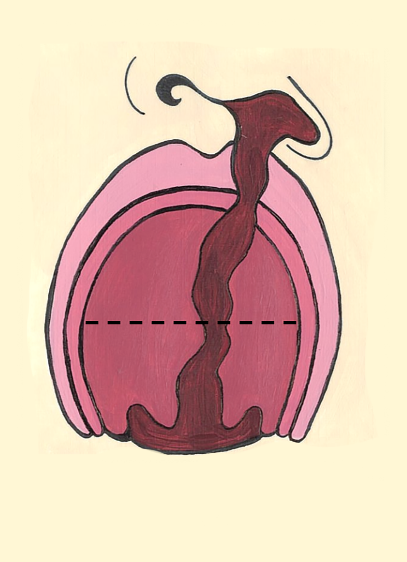 Unilateral Cleft Lip Palate