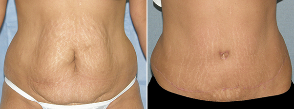 Abdominoplasty