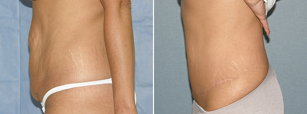Abdominoplasty