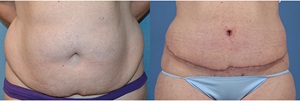 Abdominoplasty before and after image.