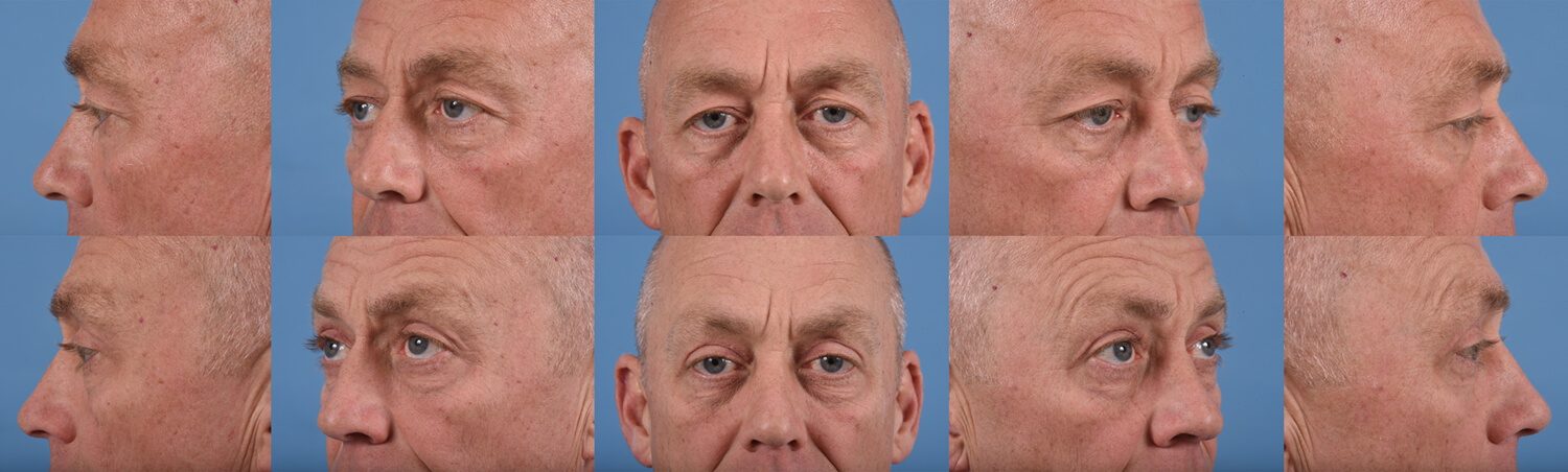 Before and after photos for a Blepharoplasty procedure.
