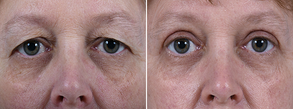 Blepharoplasty