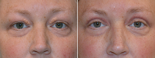 Blepharoplasty