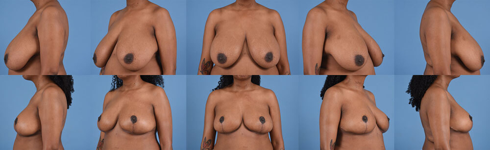 Before and after photos from multiple perspectives of a breast reduction.
