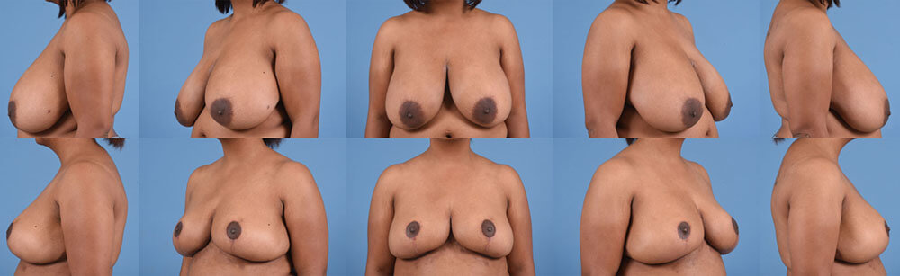 Before and after photos from multiple perspectives of a breast reduction.