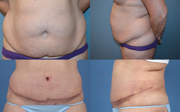 Example of Dr. David's work of abdominoplasty before and after surgery. 