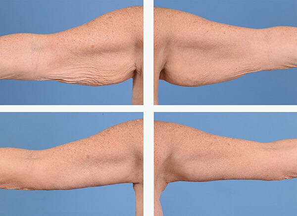 Another example of Dr. David's work of liposuction of the arms before and after surgery. 