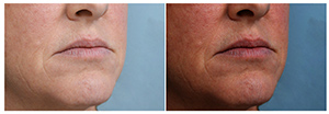 Example of Lisa David, MD's work on patient with lip augmentation.