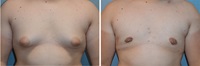 Example of patient before and after gynomatia with Dr. David.