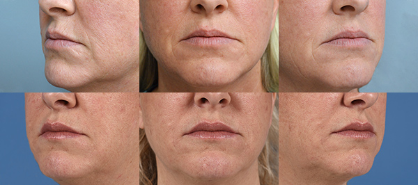 Example of Dr. David's work of lip injection before and after surgery. 