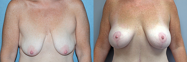 Example of Dr. David's work of breast augmentation before and after surgery. 