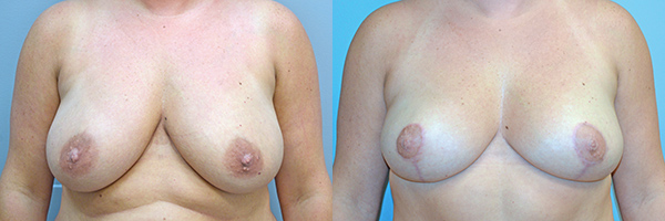 Example of Dr. David's work of breast augmentation before and after surgery. 