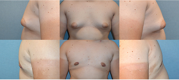 Example of Dr. David's work of gynomatia before and after surgery. 
