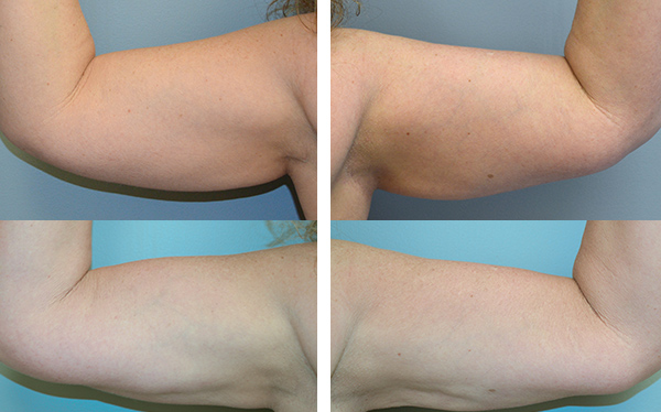 Example of Dr. David's work of liposuction of the arms before and after surgery. 