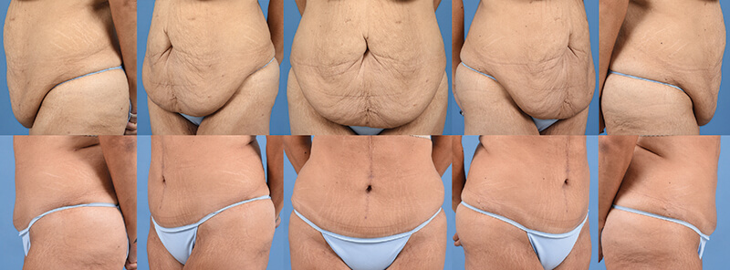 Example of patient before and after Fleur de Lis abdominoplasty with Dr. David. 