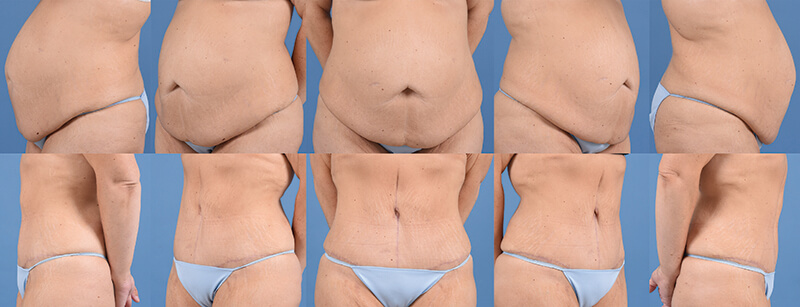 Example of before and after Fleur-de-lis abdominoplasty with Dr. David. 