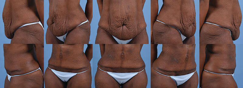 Example of Dr. David's work of Fleur-de-lis abdominoplasty before and after surgery. 