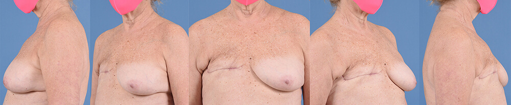 Dr. Pestana's example of breast reconstruction mastectomy revision aesthetic flat closure.