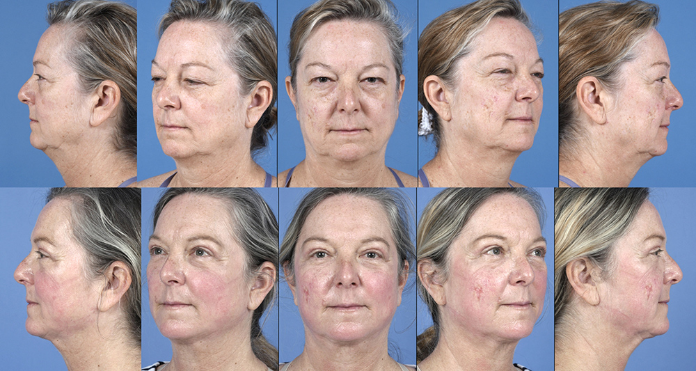 Dr. Pestana's work on a facial rejuvenation. 