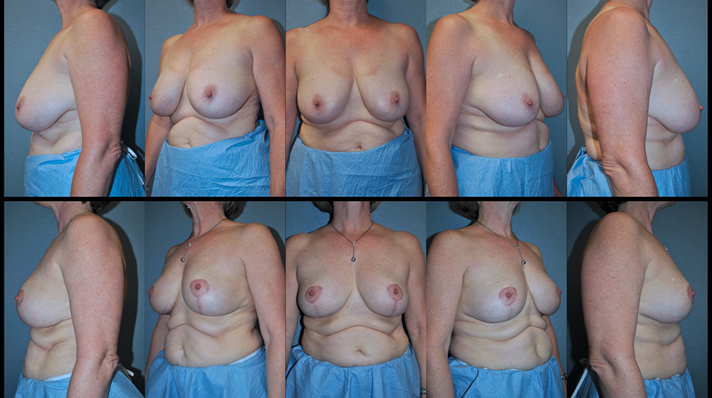 Dr. Pestana's example of breast lift. 
