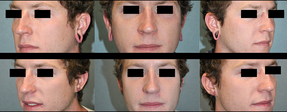 Dr. Pestana's work on an earlobe repair.