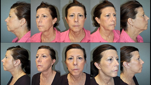 Dr. Pestana's example of work for a face and neck lift. 