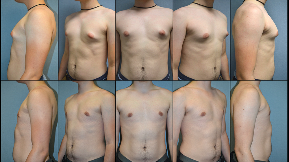 Dr. Pestana's work on a patient with gynecomastia. 