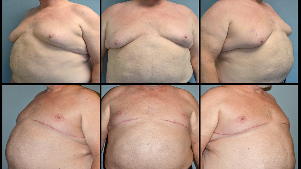Dr. Pestana's work on a patient with gynecomastia. 