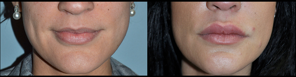 Dr. Pestana's patient example of a lip augmentation.