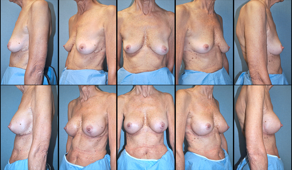 Dr. Pestana's patient before and after breast lift surgery.