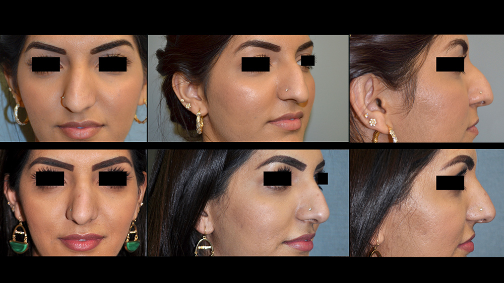 Dr. Pestana's work on rhinoplasty.