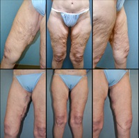 Dr. Pestana's patient before and after thigh lift surgery.