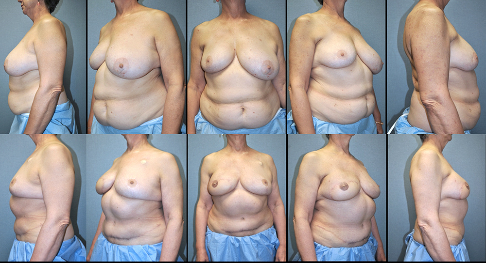 Dr. Pestana's patient who had a reconstruction autologous tissue. 